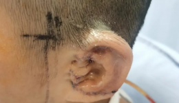 墨池醫術丨利用肋軟骨“做”個“新耳朵” 幫他拼回完整人生