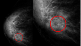乳腺彩超都做了，为什么又要喊加一个乳腺X线检查？